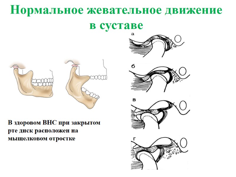 Нормальное жевательное движение в суставе В здоровом ВНС при закрытом рте диск расположен на